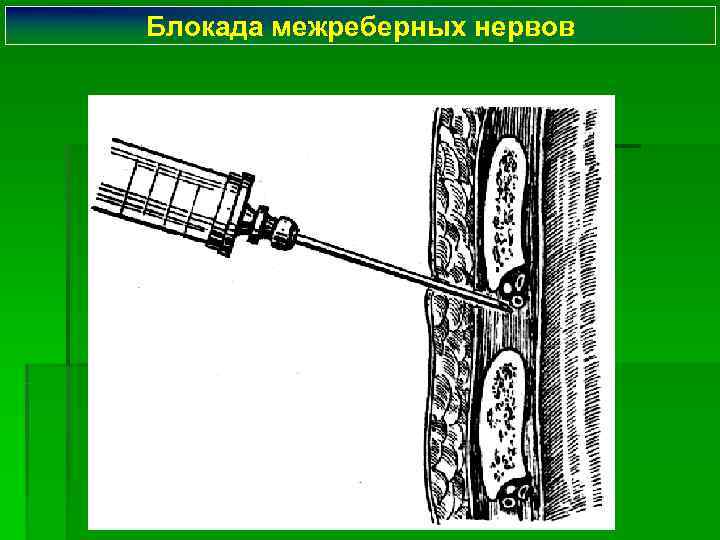 Блокада межреберных нервов 