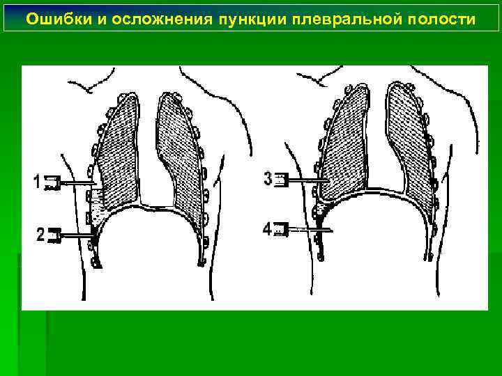 Ошибки и осложнения пункции плевральной полости 