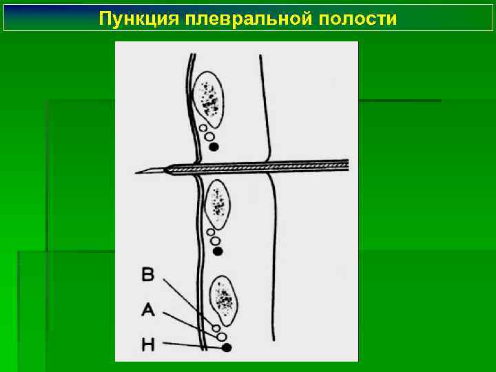 Пункция плевральной полости 