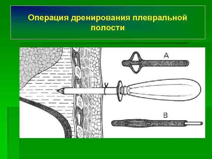 Операция дренирования плевральной   полости 