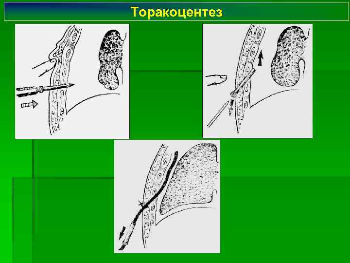 Торакоцентез 