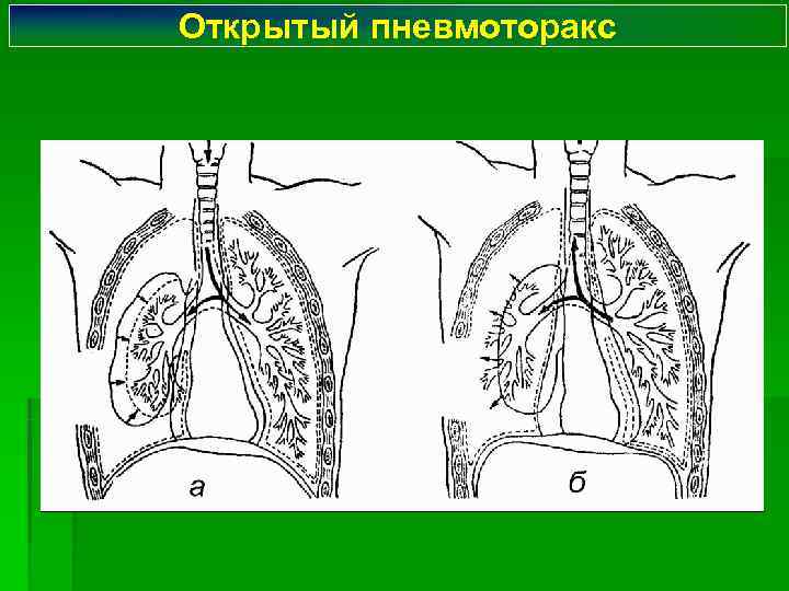 Открытый пневмоторакс 