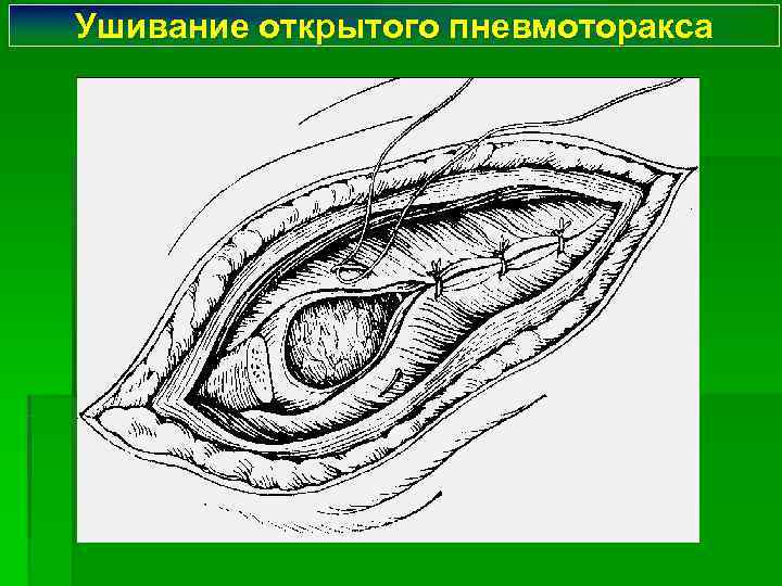 Ушивание открытого пневмоторакса 