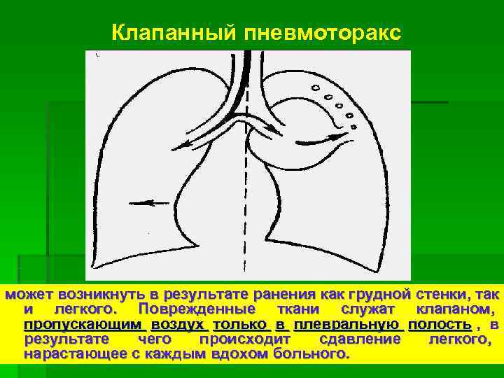    Клапанный пневмоторакс может возникнуть в результате ранения как грудной стенки, так