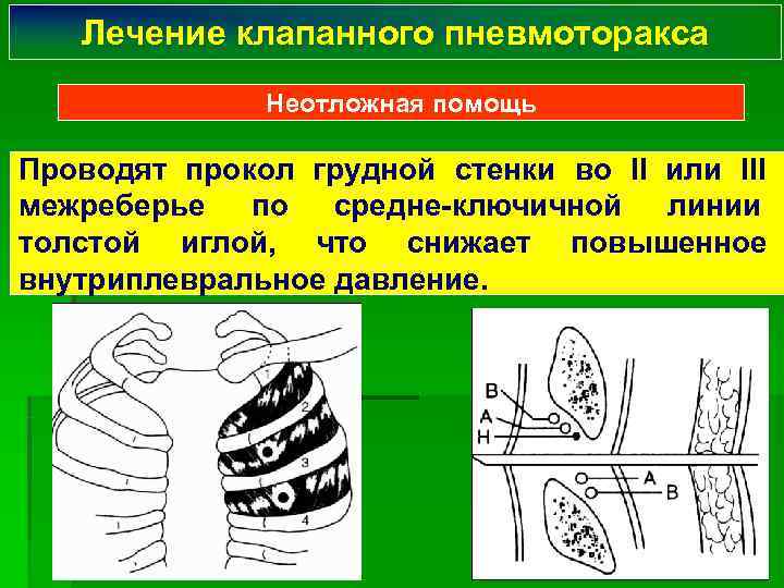   Лечение клапанного пневмоторакса    Неотложная помощь Проводят прокол грудной стенки