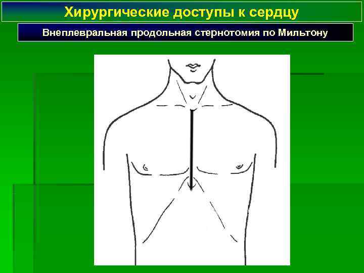   Хирургические доступы к сердцу Внеплевральная продольная стернотомия по Мильтону 