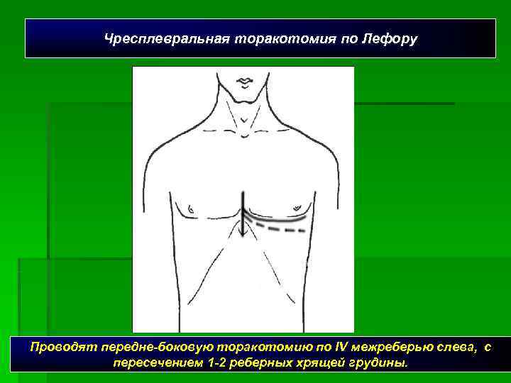    Чресплевральная торакотомия по Лефору Проводят передне-боковую торакотомию по IV межреберью слева,