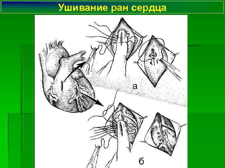 Ушивание ран сердца 
