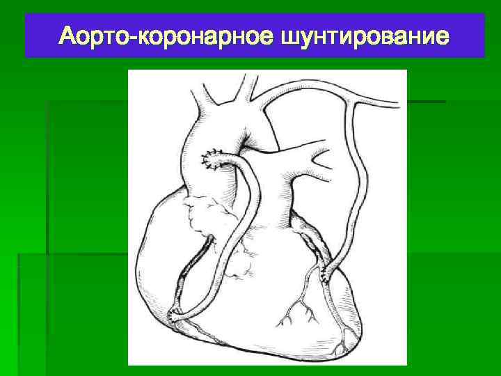 Аорто-коронарное шунтирование 