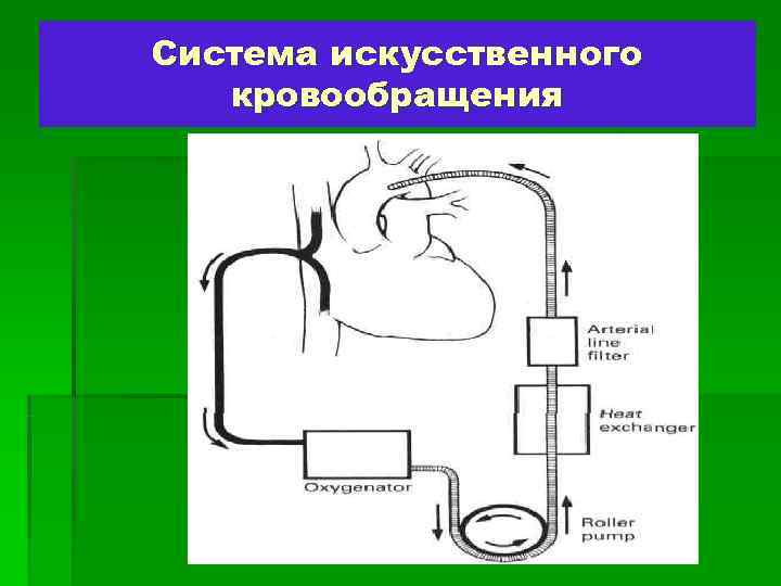 Система искусственного  кровообращения 