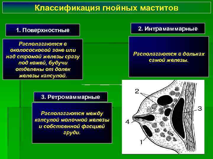    Классификация гнойных маститов 1. Поверхностные   2. Интрамаммарные  Располагаются