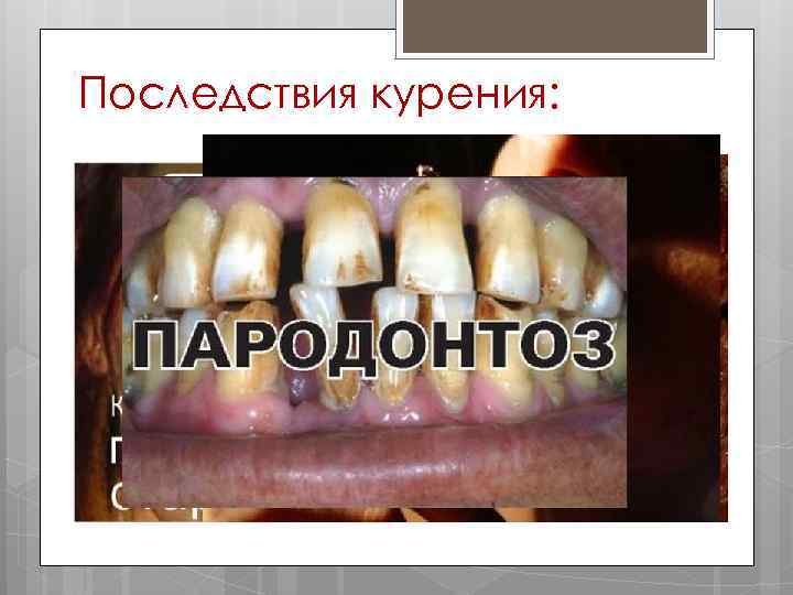 Последствия курения: 