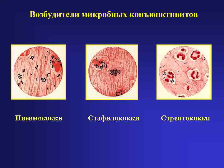   Возбудители микробных конъюнктивитов Пневмококки  Стафилококки  Стрептококки 