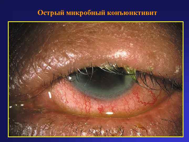 Острый микробный конъюнктивит 