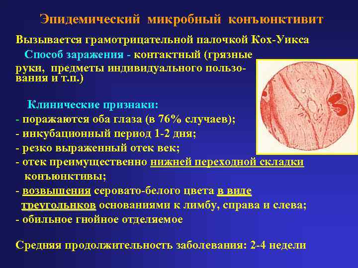   Эпидемический микробный конъюнктивит Вызывается грамотрицательной палочкой Кох-Уикса Способ заражения - контактный (грязные
