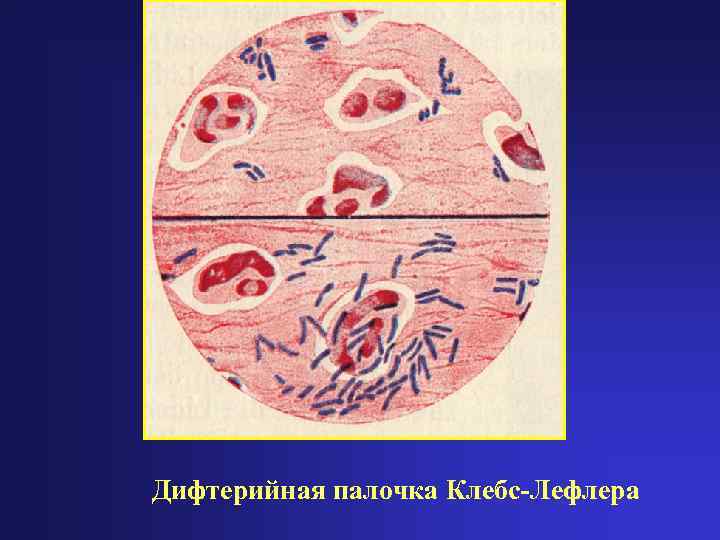 Дифтерийная палочка Клебс-Лефлера 