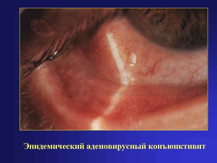 Эпидемический аденовирусный конъюнктивит 