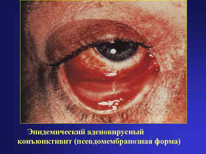  Эпидемический аденовирусный конъюнктивит (псевдомембранозная форма) 