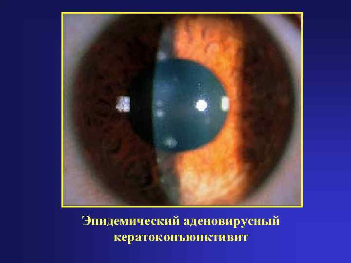 Эпидемический аденовирусный кератоконъюнктивит 
