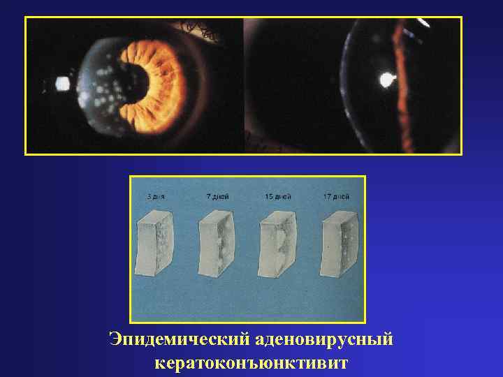 Эпидемический аденовирусный кератоконъюнктивит 