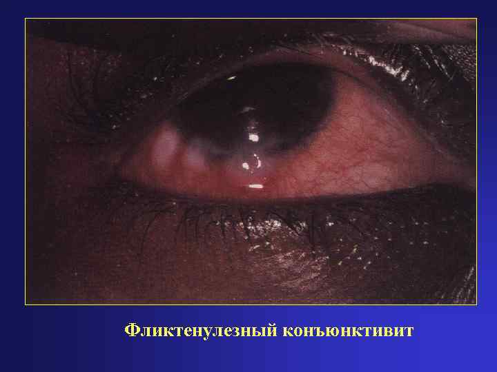 Фликтенулезный конъюнктивит 