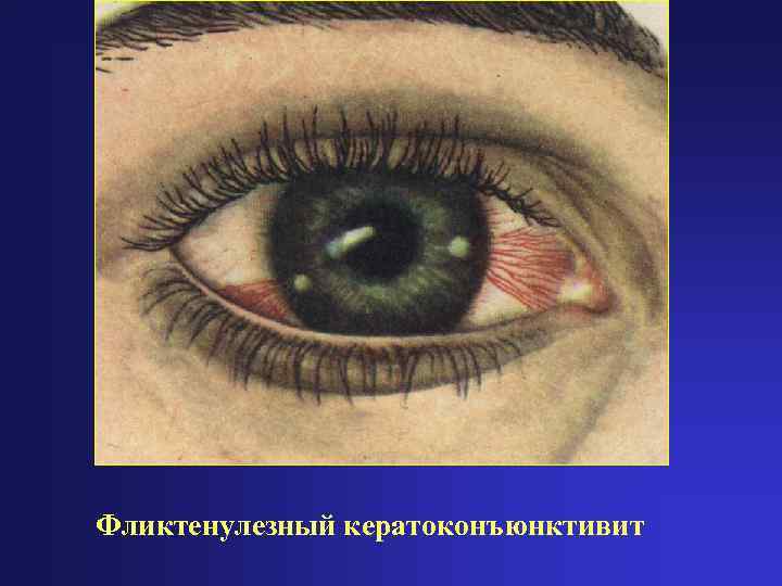 Фликтенулезный кератоконъюнктивит 
