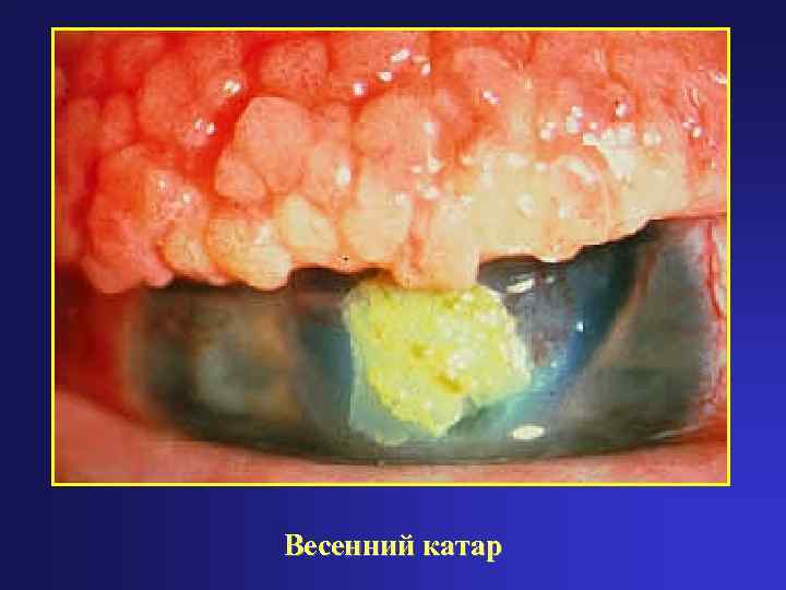 Весенний катар 