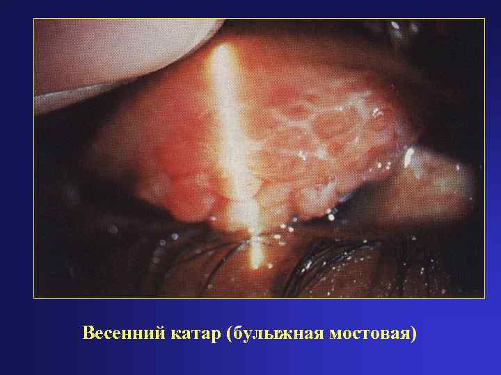 Весенний катар (булыжная мостовая) 