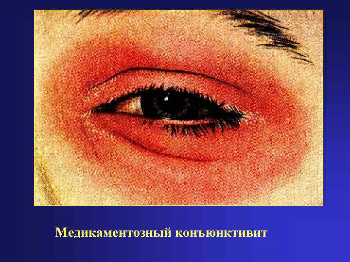 Медикаментозный конъюнктивит 