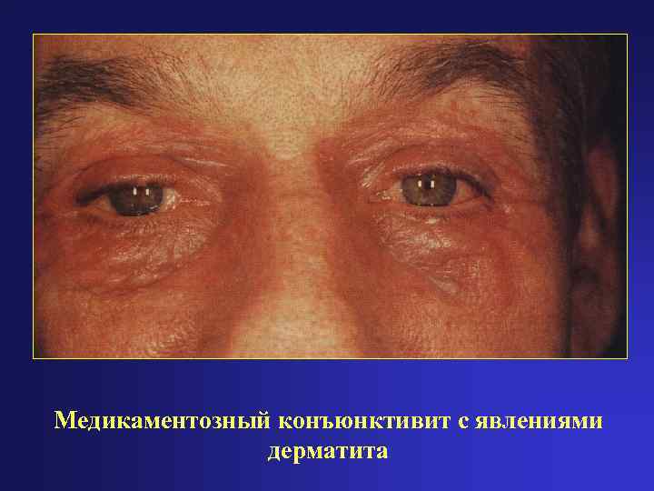 Медикаментозный конъюнктивит с явлениями    дерматита 
