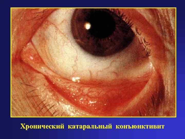 Хронический катаральный конъюнктивит 