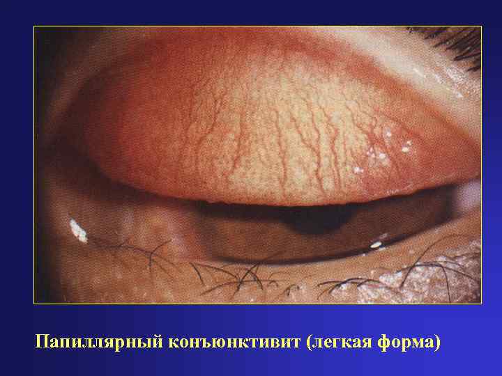 Папиллярный конъюнктивит (легкая форма) 