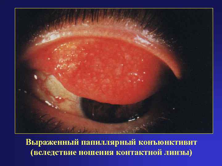 Выраженный папиллярный конъюнктивит (вследствие ношения контактной линзы) 