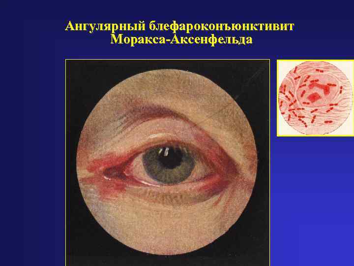 Ангулярный блефароконъюнктивит  Моракса-Аксенфельда 