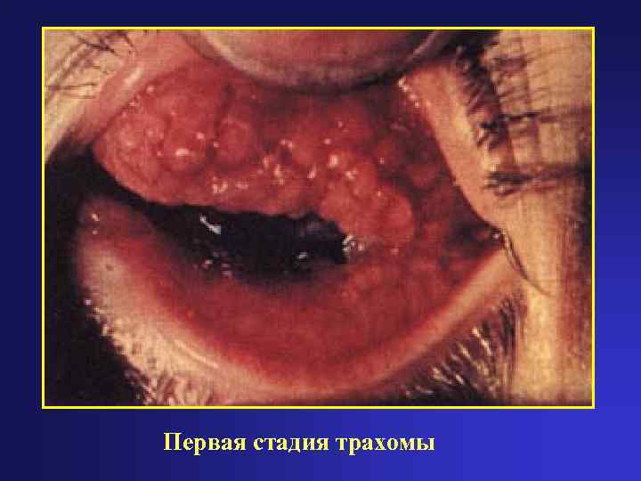 Первая стадия трахомы 