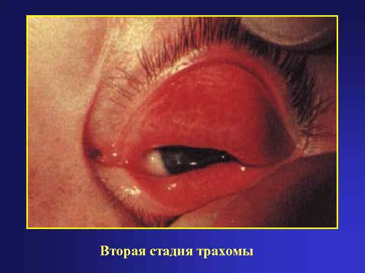 Вторая стадия трахомы 