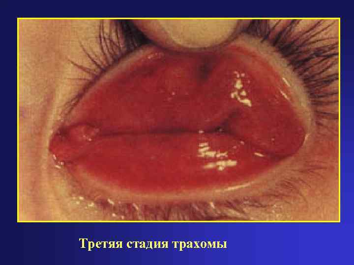 Третяя стадия трахомы 