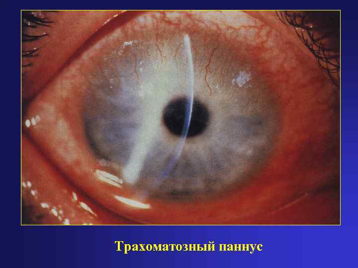 Трахоматозный паннус 