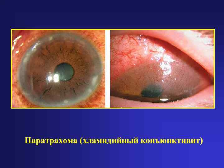 Паратрахома (хламидийный конъюнктивит) 