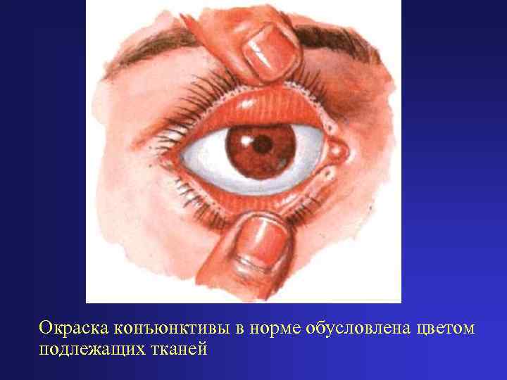 Окраска конъюнктивы в норме обусловлена цветом подлежащих тканей 