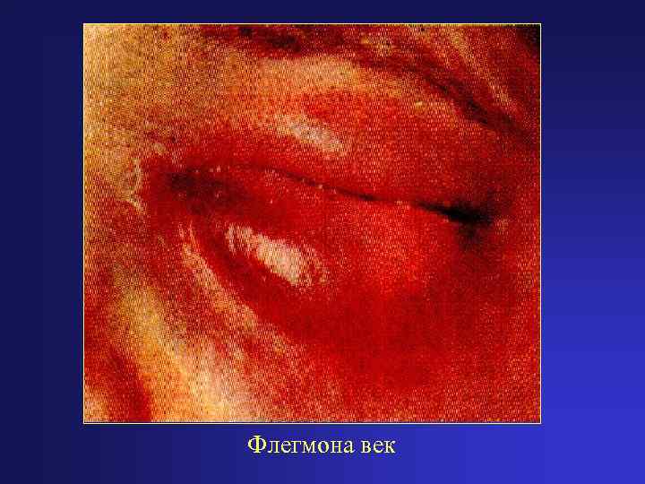 Флегмона век 