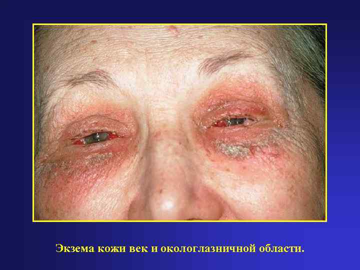 Экзема кожи век и окологлазничной области. 
