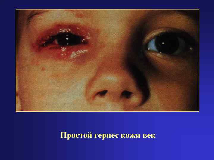 Простой герпес кожи век 