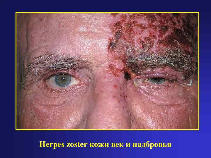 Herpes zoster кожи век и надбровья 