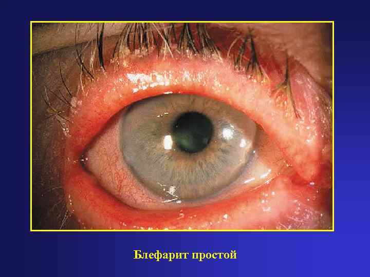 Блефарит простой 