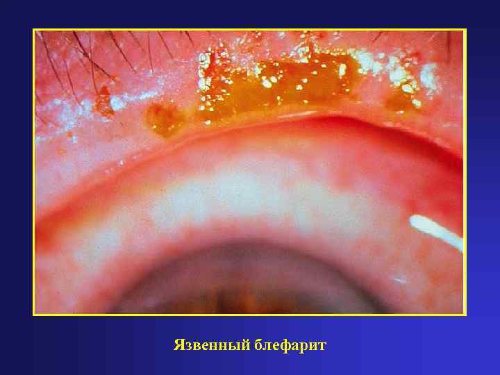 Язвенный блефарит 