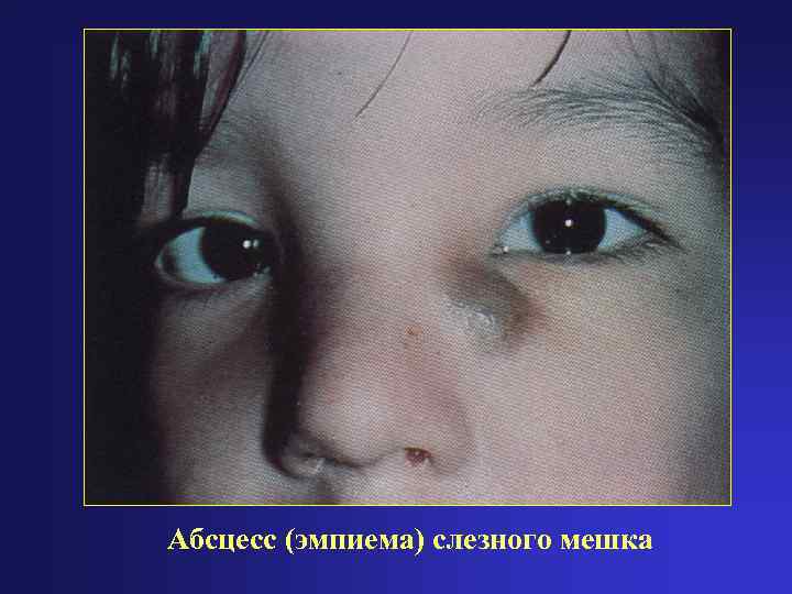 Абсцесс (эмпиема) слезного мешка 