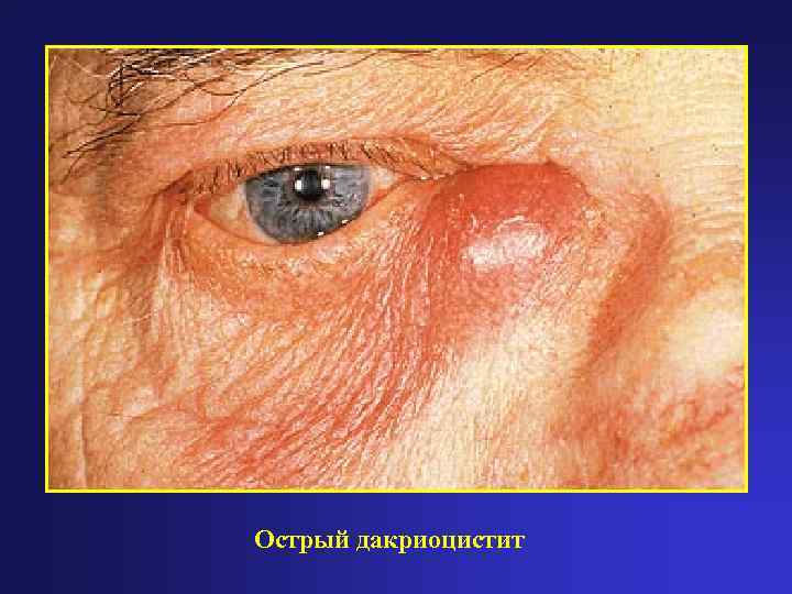 Острый дакриоцистит 