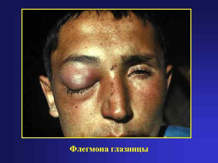 Флегмона глазницы 