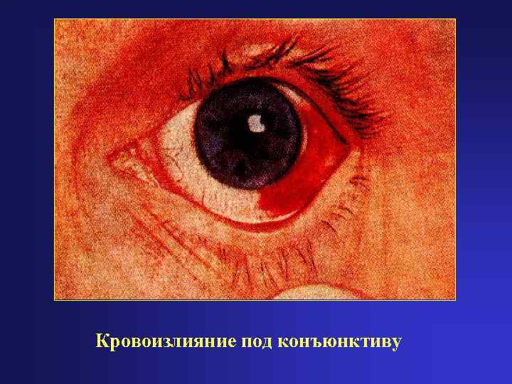 Кровоизлияние под конъюнктиву 